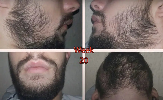 Minoxidil and Beard Growth: Guide For Beginners